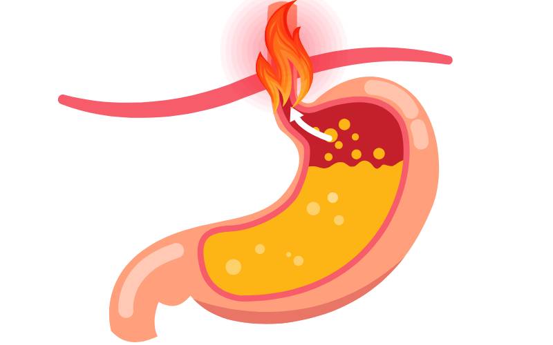 Reflusso Gastroesofageo, grafica stilizzata che indica lo stomaco e il reflusso acido che risale causando sofferenza all'esofago